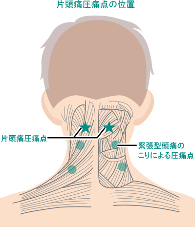 片頭痛圧痛点の位置