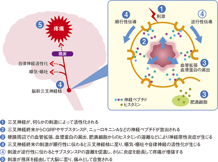 片頭痛が起こるメカニズムの模式図