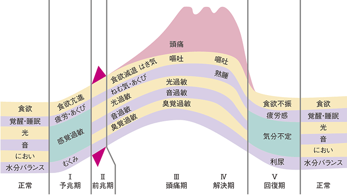 片頭痛の予兆期、前兆期、頭痛期、回復期の経過図